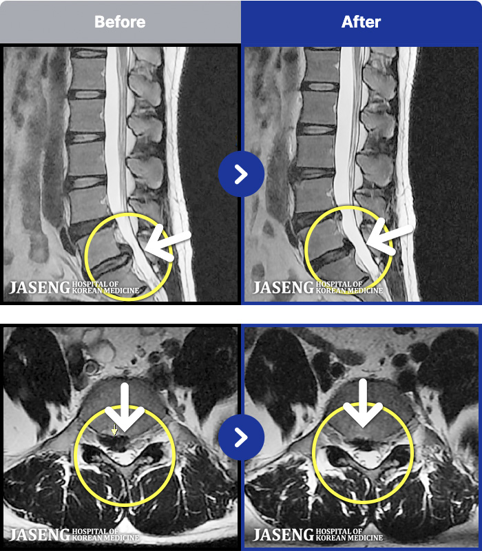 ���ڻ��ѹ溴�� ġ���� MRI�� ���� ġ����-�㸮 ���� ��� ����