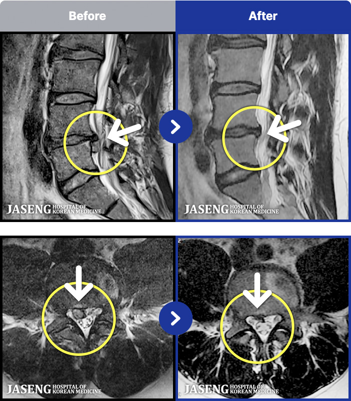 ���ڻ��ѹ溴�� ġ���� MRI�� ���� ġ����-��������� ���ϰ� �߱��� ���� 10���̻� ���� �� ����.