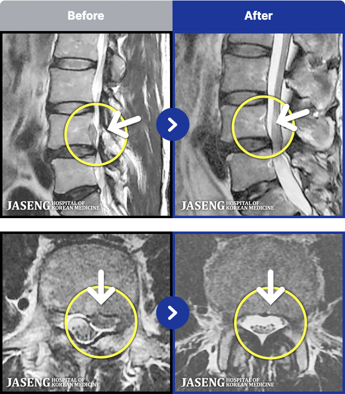 �ڻ��ѹ溴�� ġ���� MRI�� ���� ġ����-���� ����������� ���Ͽ� ��ü� Ÿ�� �����Ͽ����ϴ�.