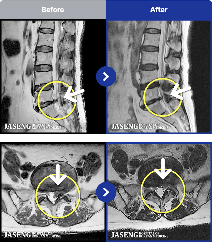 �ϻ��ڻ��ѹ溴�� ġ���� MRI�� ���� ġ����-�㸮, ���� ��ݺ��� ���� �ٸ����� ���� �� ������ ���ӵǰ�, �㿡 �� �� ���� �ٸ��� �㰡 ���� ���� �� ���� ������ �� ��ȭ�Ǵ� ����� ȣ���ϴ� ���¿����ϴ�.