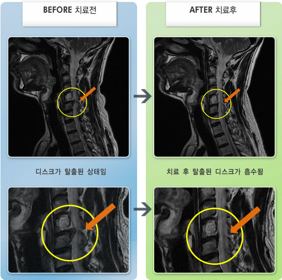 자생한방병원 치료사례 MRI로 보는 치료결과-우측 상지 통증이 심하여 누워서 수면을 어려운 상태