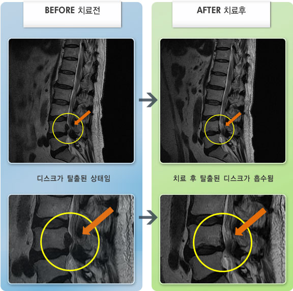 자생한방병원 치료사례 MRI로 보는 치료결과-양쪽 다리 통증이 심한 상태