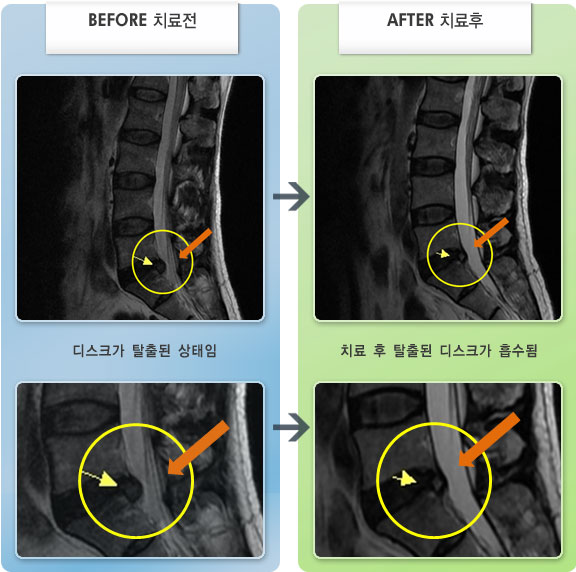자생한방병원 치료사례 MRI로 보는 치료결과-오른쪽 허벅지 뒤로 찌르는 통증이 있었다.