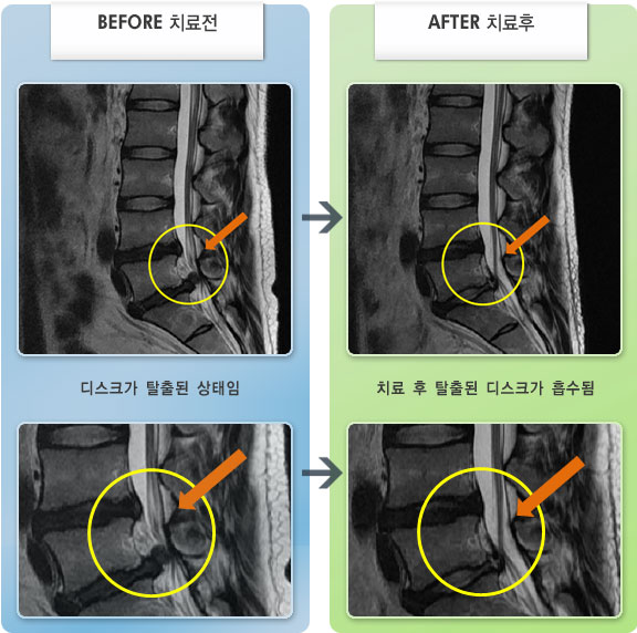 자생한방병원 치료사례 MRI로 보는 치료결과-좌위시, 기립시 통증
