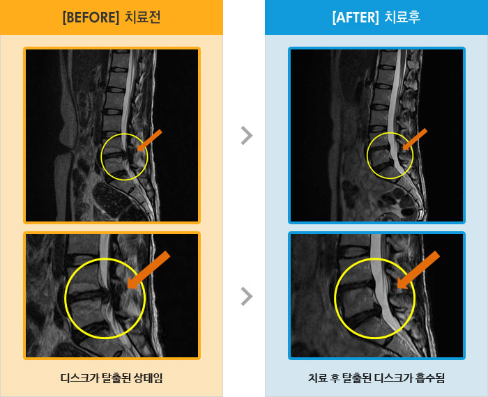 자생한방병원 치료사례 MRI로 보는 치료결과-심한 허리 통증으로 허리 숙일 때와 앉았다 일어날 때 힘듬