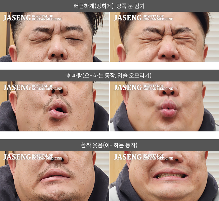 보라매자생한방병원_안면신경마비 치료 전후 사례