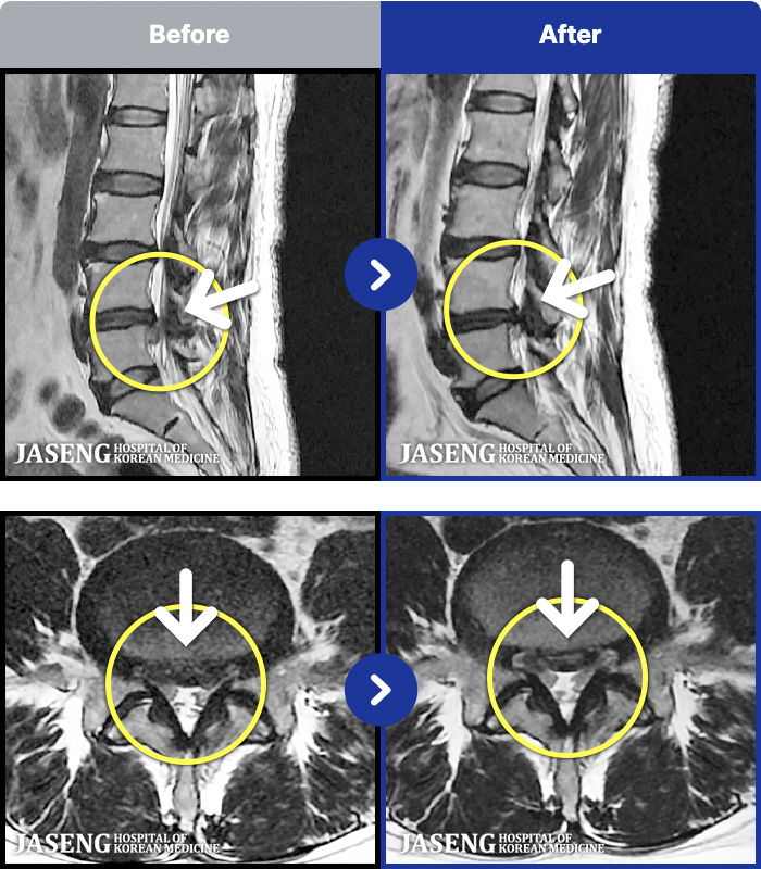 잠실자생한방병원 MRI 치료 전후 사례