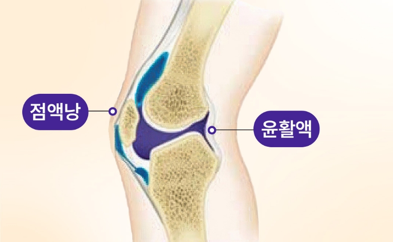 무릎의 점액낭이 찬 일러스트